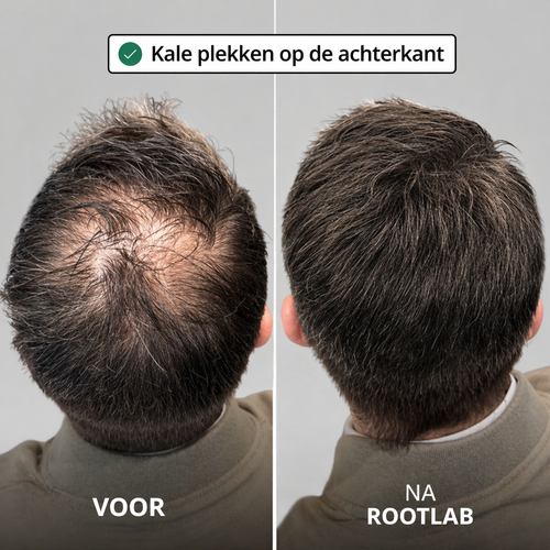 Hairox™ | APEX HAARGROEI SYSTEEM